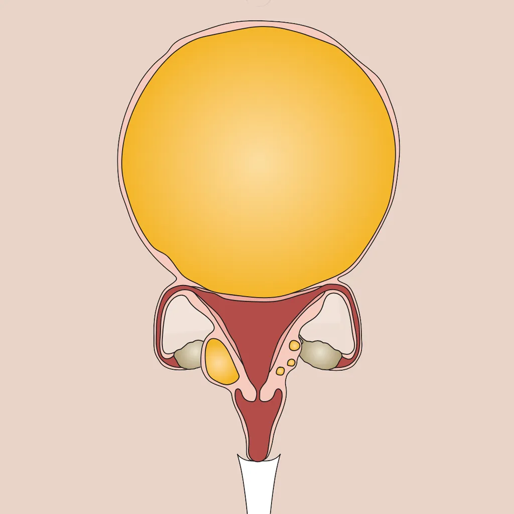 fibroid cover